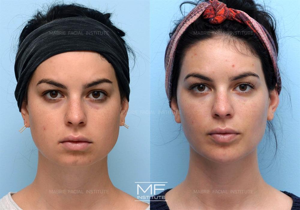 Before and after of case 432. Brunette woman who received a combination of Botox to Masseters and Fillers in cheek bones providing more definition to face