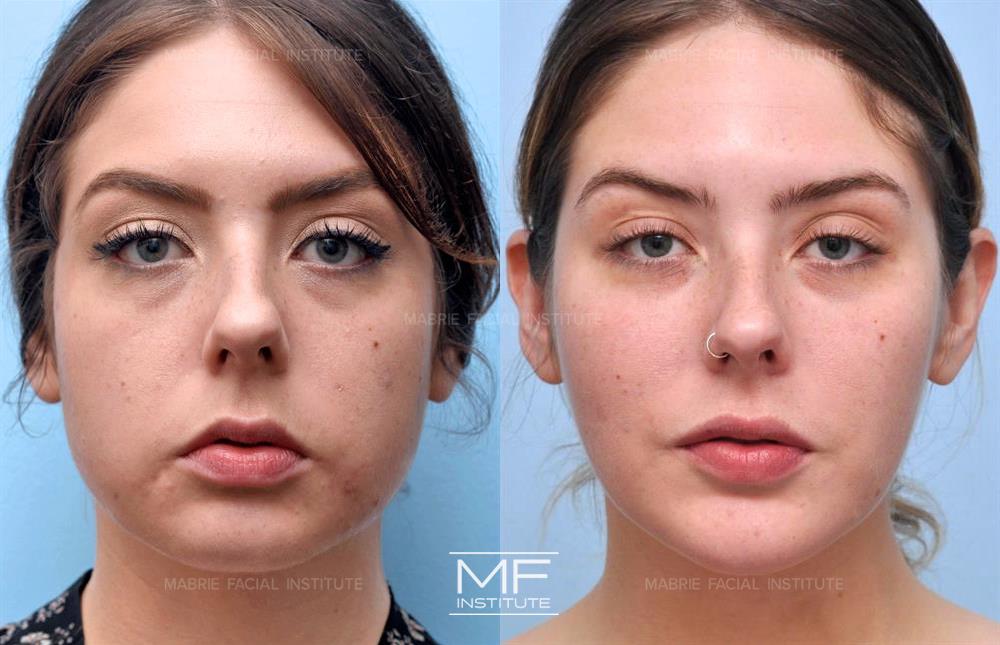 Before and after of case 432. Brunette woman who received a combination of Botox to Masseters and Fillers in cheek bones providing more definition and slimmer face
