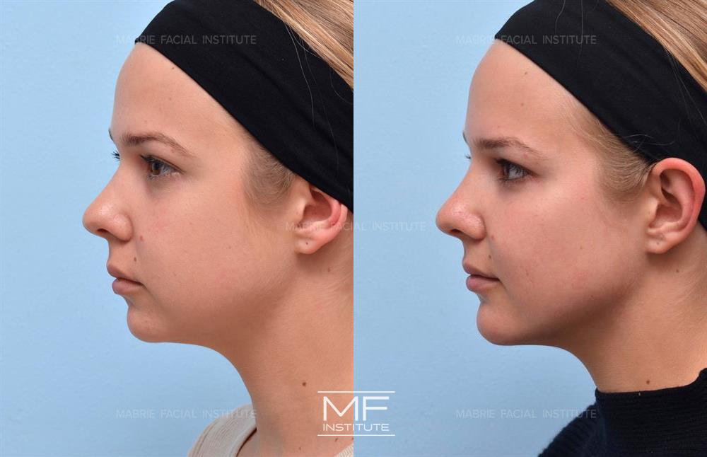 Before and after of case 598. Blonde woman client whose added fillers to cheekbones providing more definition in cheeks