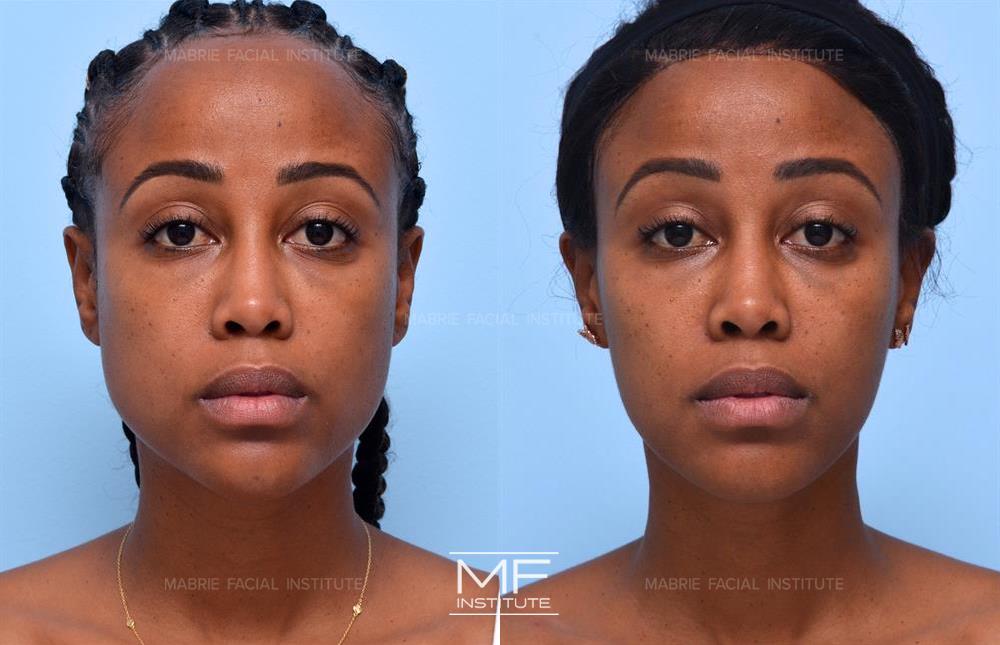 Before and after of case 432. African American woman who received Botox to Masseters providing thinner cheeks