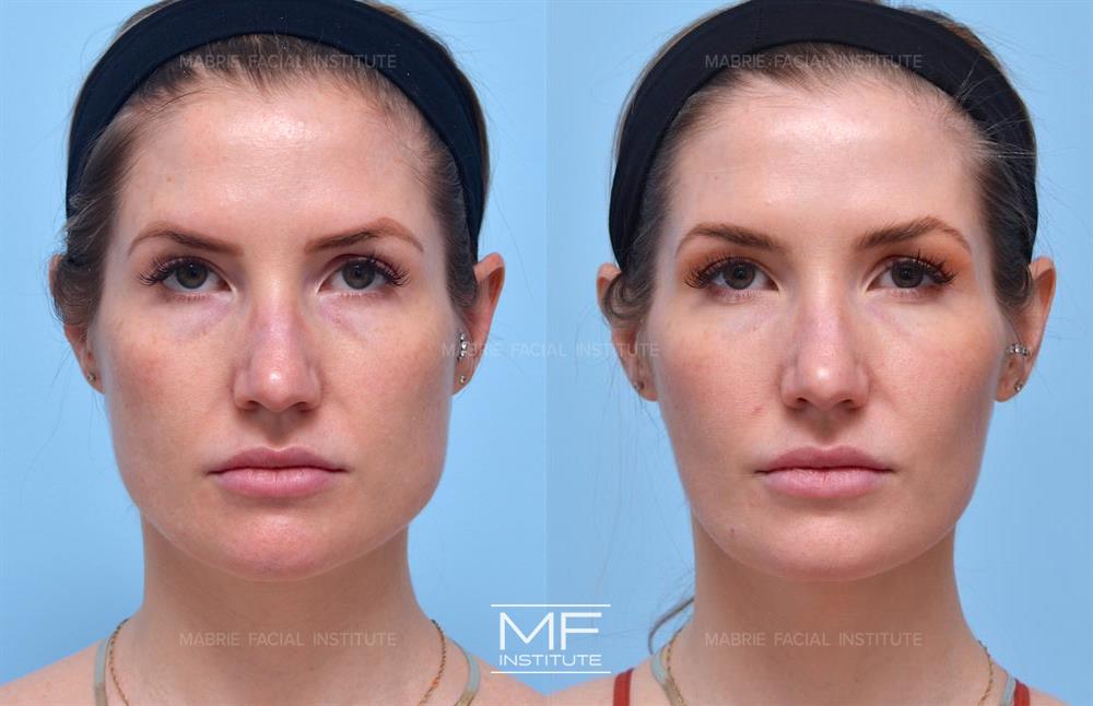 Before and after of case 432. brunette woman who received Botox to Masseters providing thinner cheeks, less square jaw and cheeks