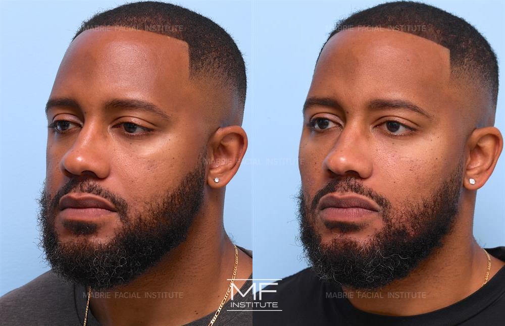 Before and after of case 763. African American male client whose added fillers to cheekbones providing more definition in cheeks and smoother eyes.