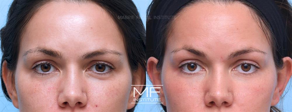 Before and after of brunette patient. Procedure provided with a reduction of crows feet wrinkling around the eyes