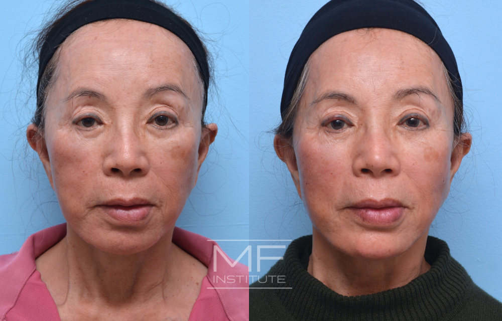 Before and After Under Eye Filler For a Patient in Their 70s