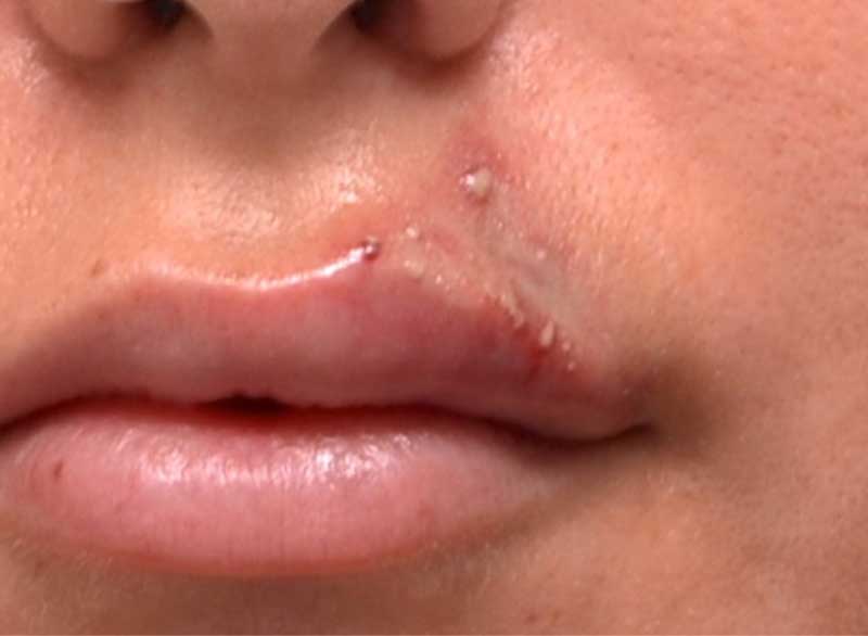 A woman showing blistering after filler treatment
