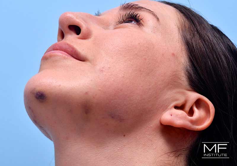 A woman showing common signs of bruising underneath the chin after BOTOX