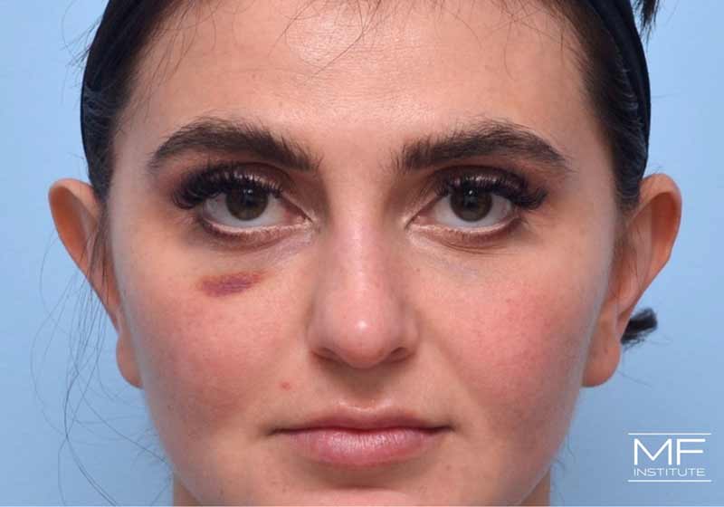 A woman showing uncommon, but normal signs of bruising underneath the eye after BOTOX