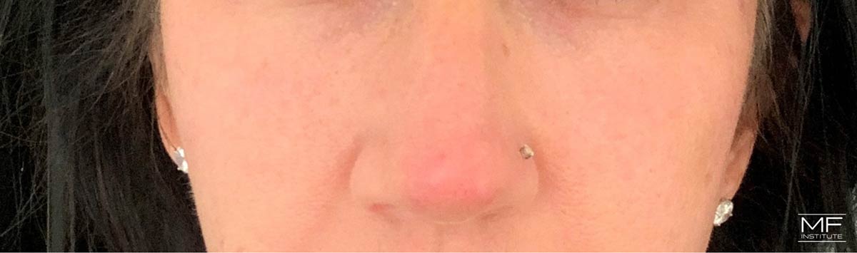 A woman showing signs of mild redness around the nose after dermal fillers