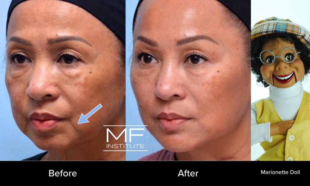 Real MFI patient before-and-after results showcasing marionette line treatment compared to marionette doll