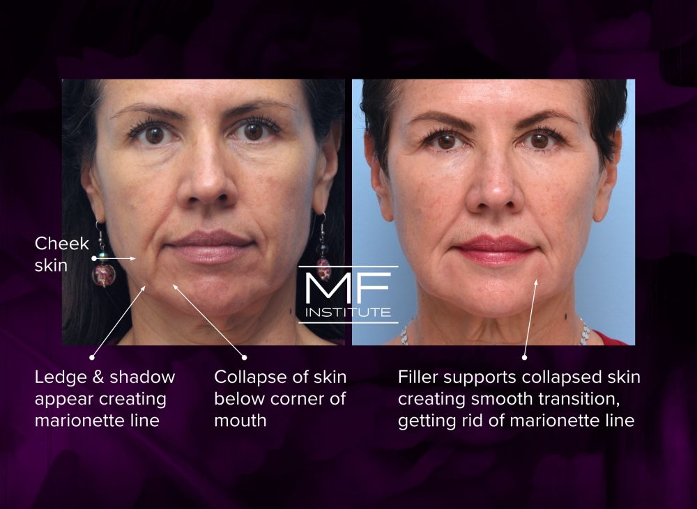 Inforgraphic detailing how filler can help reduce the appearance of marionette lines