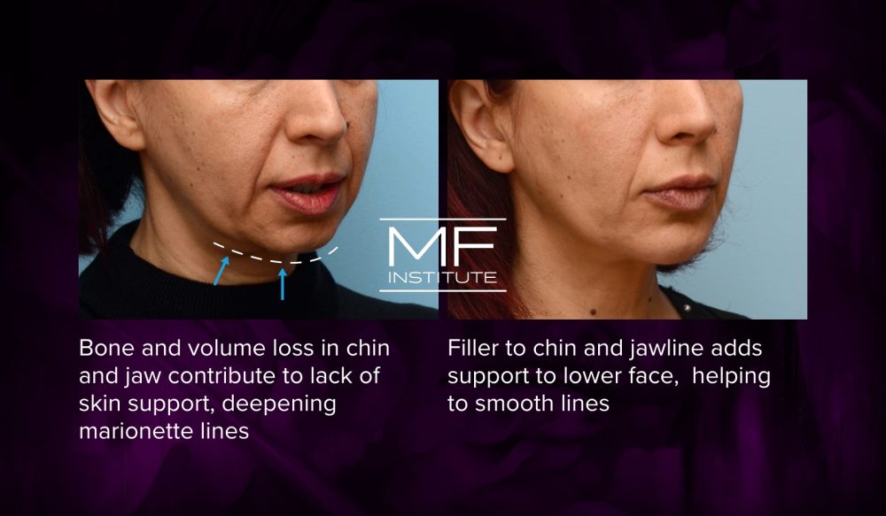 Inforgraphic detailing how chin and jawline filler can help reduce the appearance of marionette lines