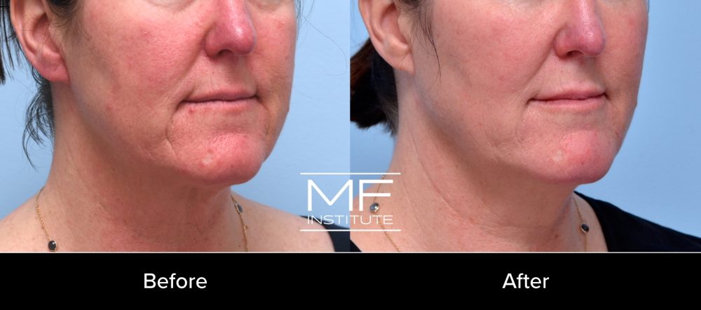 MFI before-and-after results of minimal, superficial volume loss to the oral commissure treated with filler