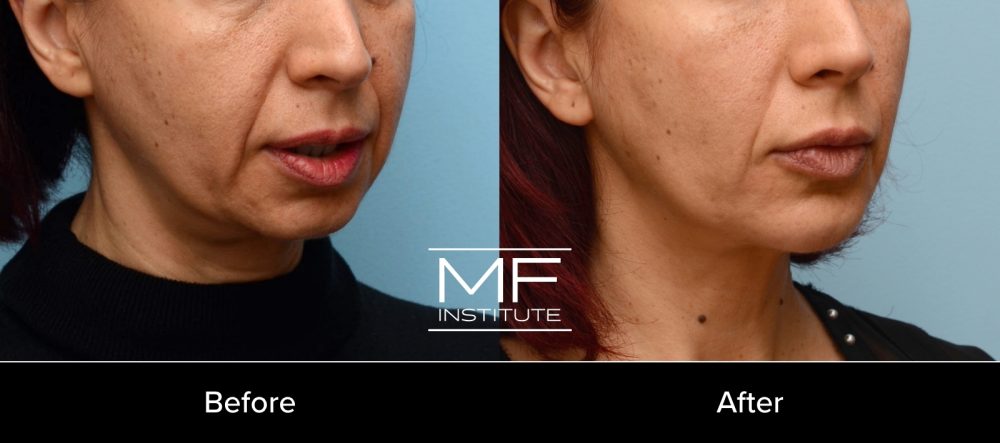 MFI before-and-after results of severe volume loss to the oral commissure treated with filler