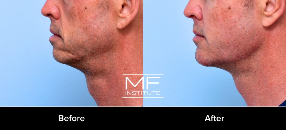 MFI before-and-after results of how to treat marionette lines by addressing the chin, jawline, and corners of the mouth together.