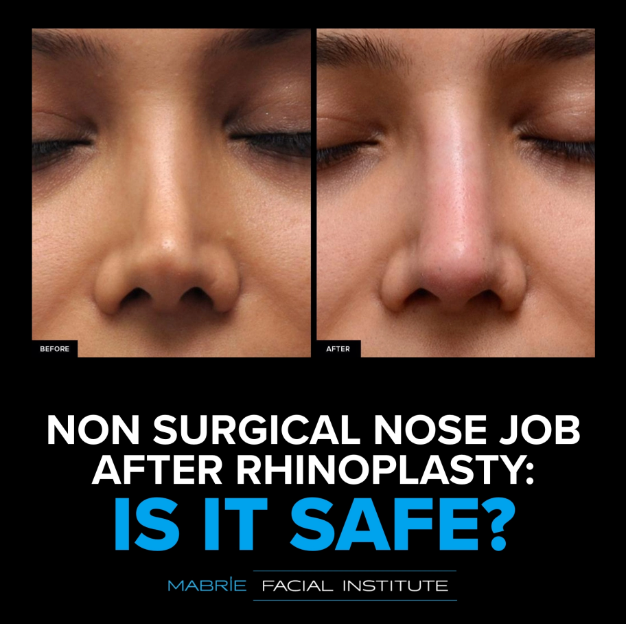Real patient before and after photos of nose