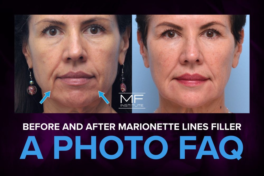 Real MFI patient before-and-after results showcasing marionette lines treatment