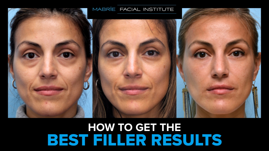 Dermal filler results created by Dr. David Mabrie in San Francisco, CA after a series of treatments.