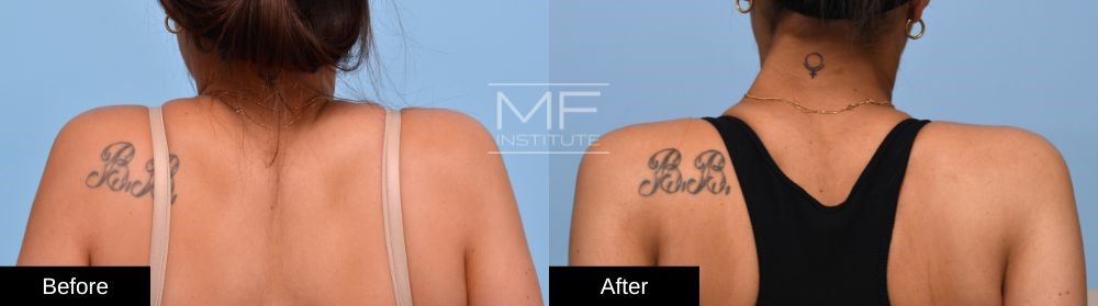 Before-and-after Trap BOTOX Case #1002 shoulder tense view