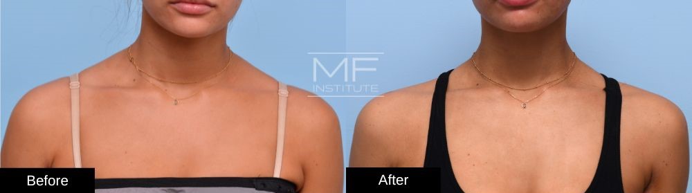 Before-and-after Trap BOTOX Case #1002 front view