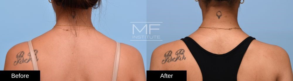 Before-and-after Trap BOTOX Case #1002 back view