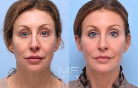 Before and after corrective injections case #1033