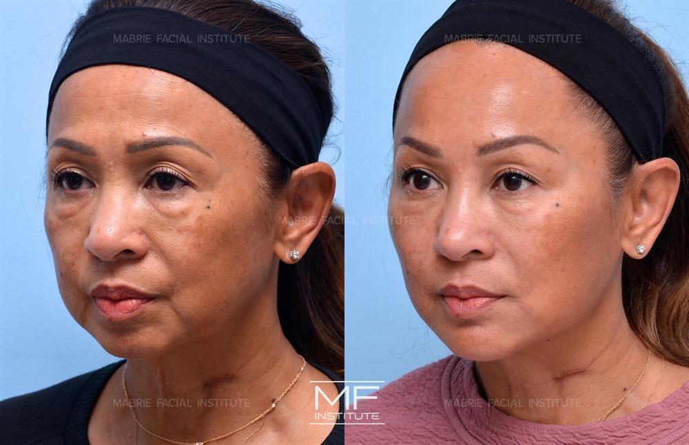 Nonsurgical facelift before and after, case #735