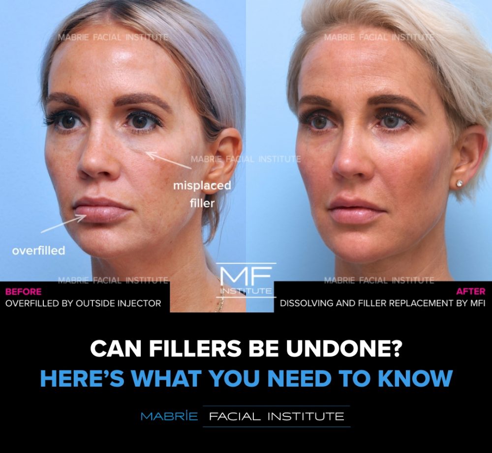 Before and after filler dissolving and replacement on a woman’s face. “Can Fillers Be Undone? Here's What You Need to Know” Mabrie Facial Institute logo