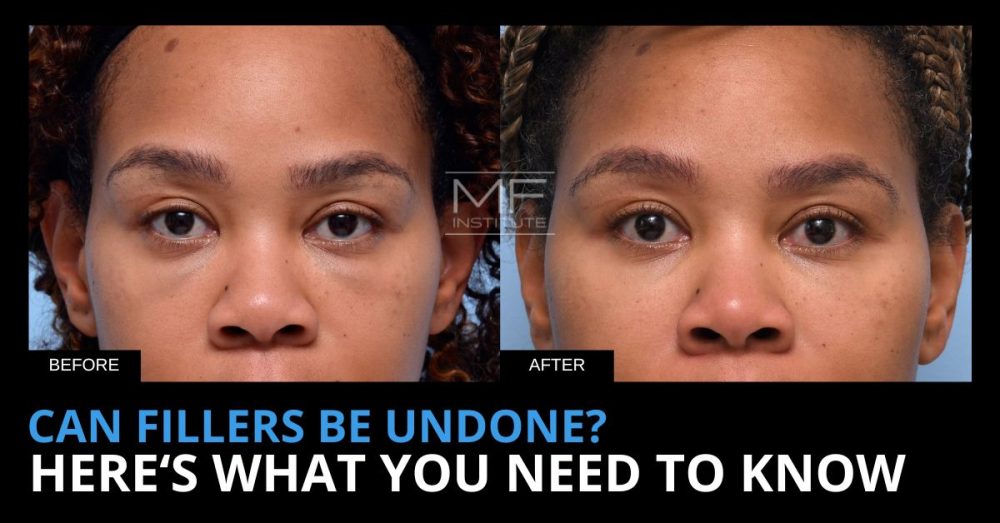 Real MFI Patient Results | Before and After Filler Dissolver Case #717 and text that reads 'Can Fillers Be Undone? Here's What You Need To Know'