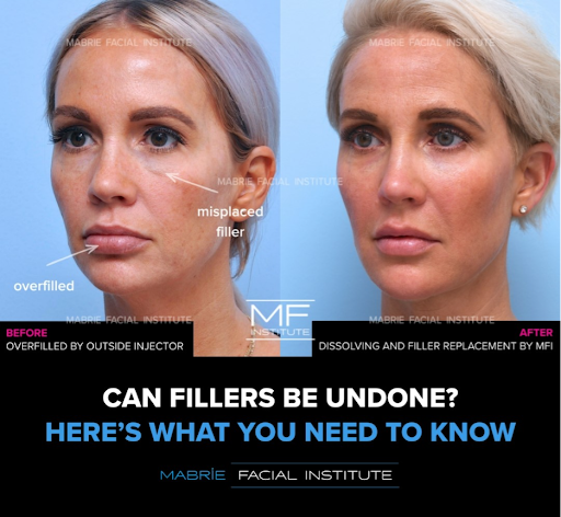Before and after filler dissolving and replacement on a woman’s face. “Can Fillers Be Undone? Here's What You Need to Know” Mabrie Facial Institute logo