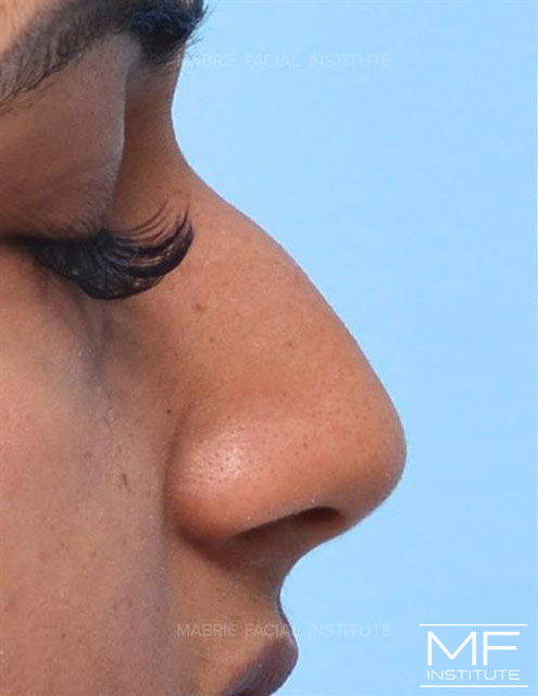 Profile close up of a woman's nose, before non surgical rhinoplasty treatment.
