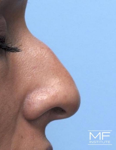 Closeup of a woman's nose before nonsurgical nose job with fillers treatment.