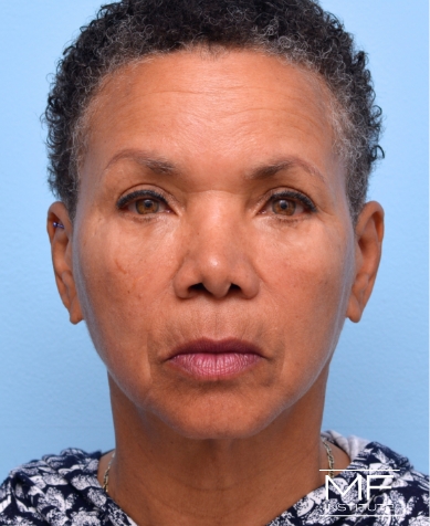 Woman after Filler for Under Eye Wrinkles treatment.