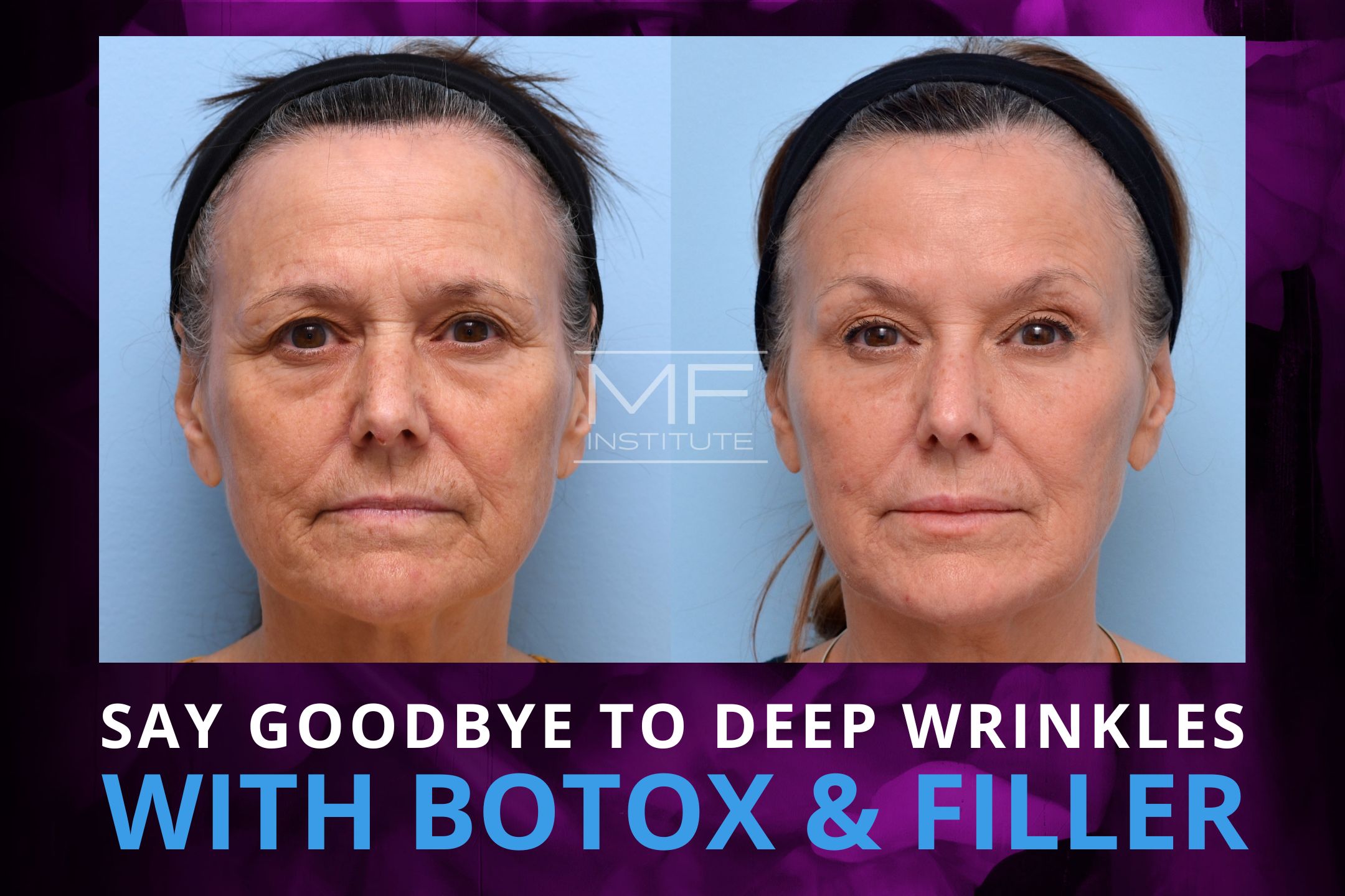 What’s the Best Treatment for Deep Wrinkles on the Face? – Mabrie 