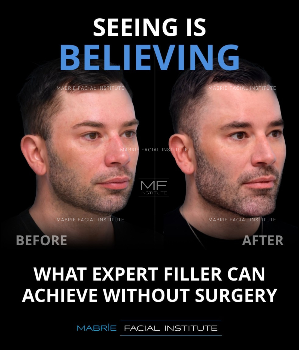 Real patient before-and-after photos with text that reads 'Seeing Is Believing What Expert Filler Can Achieve Without Surgery'