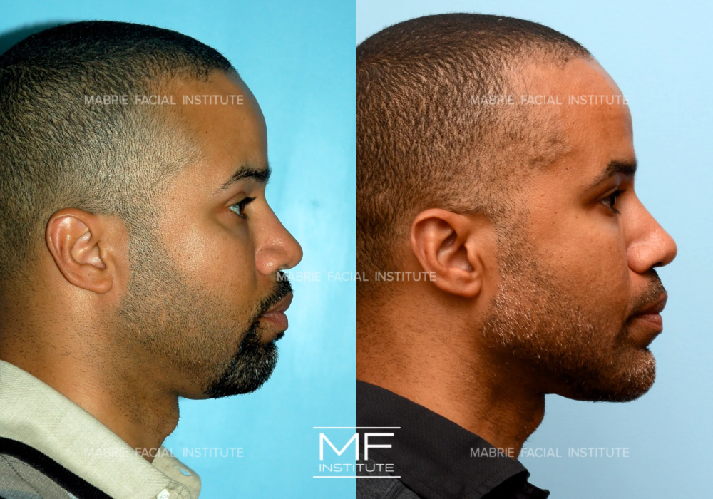 Before and after chin projection case #1139