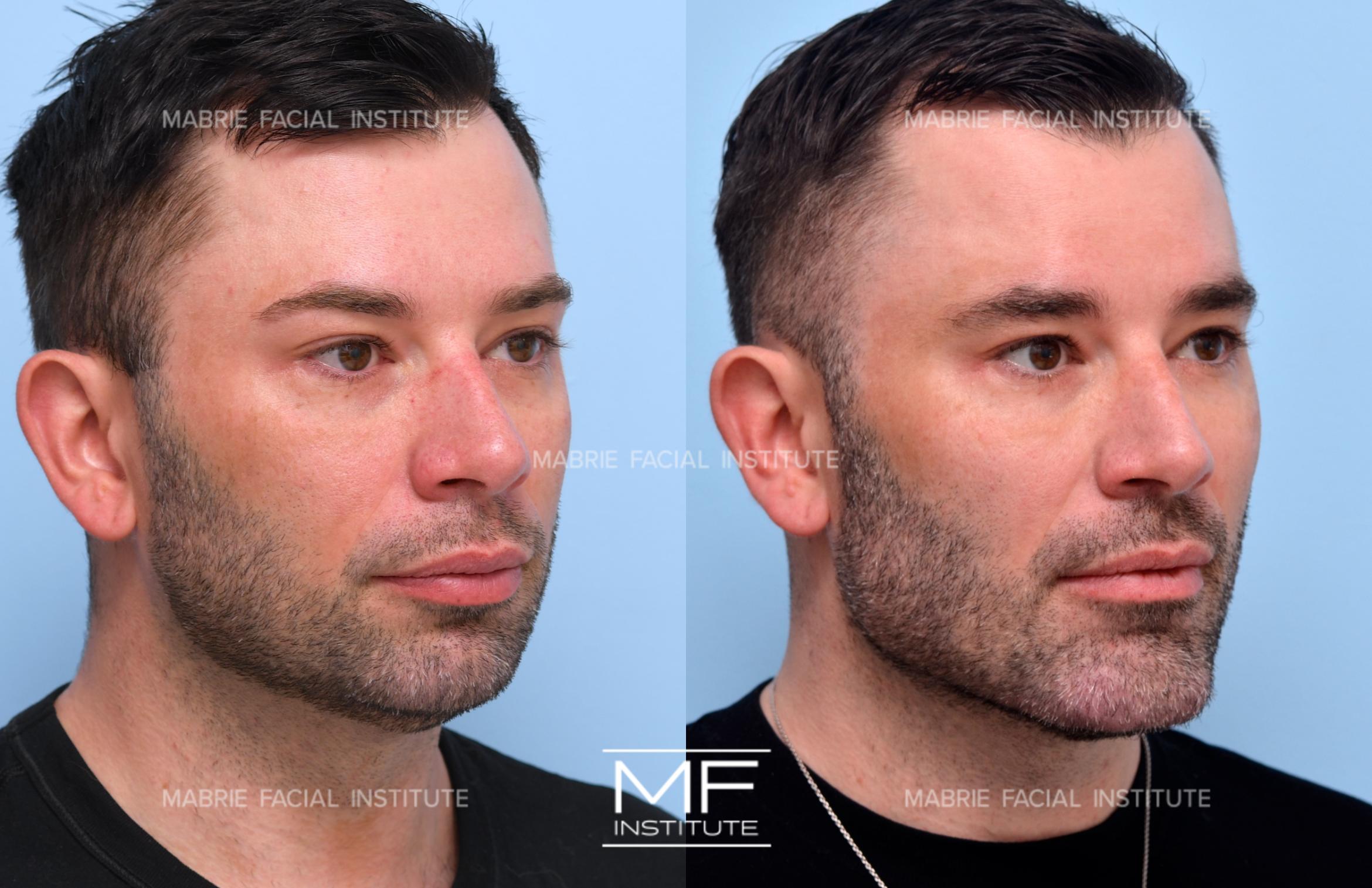 Before and after jawline filler to snatch your face case #726