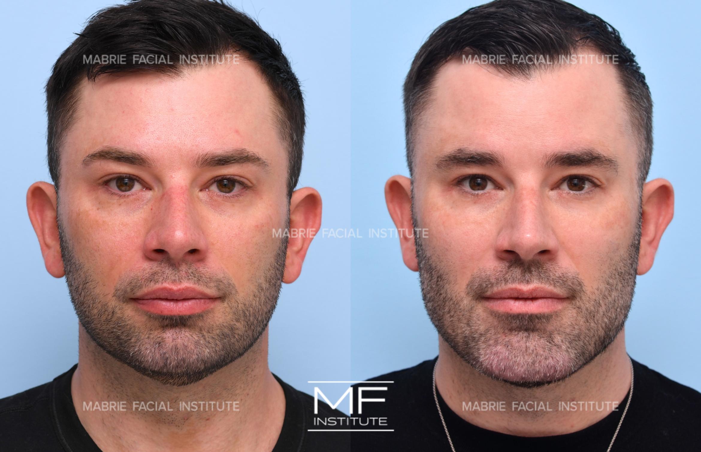 Before and after chin filler to make the chin wider or more square case #726