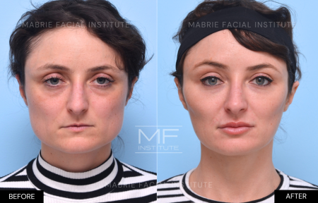 Dysport, Daxxify & XEOMIN vs. BOTOX | Mabrie Facial Institute