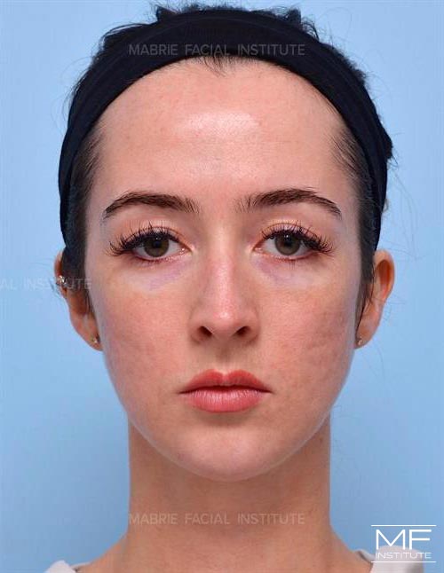 Woman after Chin Augmentation with Filler treatment.