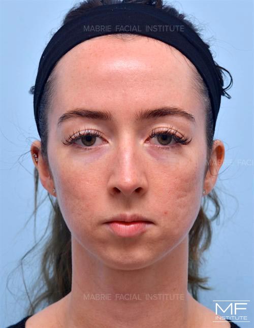 Woman before Chin Augmentation with Filler treatment.