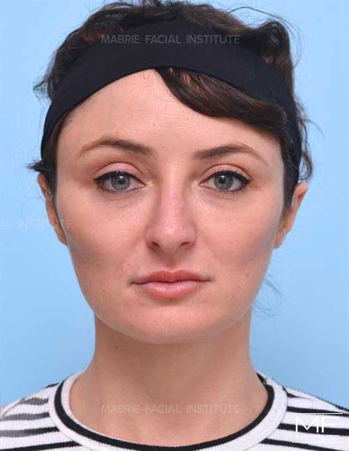 Woman after Contouring for the Round Face.
