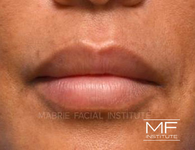 Closeup of woman's lips after Bold and Beautiful Lip Filler treatment.
