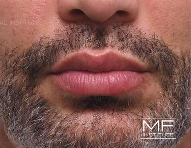 Closeup of man's lips after Bold and Beautiful Lip Filler treatment.