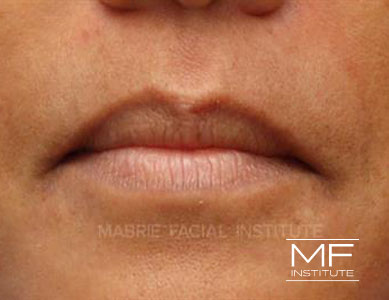 Closeup of woman's lips before Bold and Beautiful Lip Filler treatment.