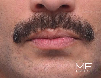 Closeup of man's lips before Bold and Beautiful Lip Filler treatment.