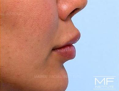 Woman's lips after Lip Filler Correction.