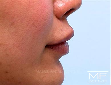 Woman's lips before Lip Filler Correction.