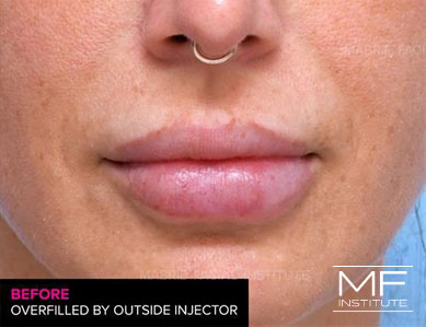 Woman's lips before Lip Filler Correction.