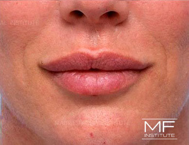 Closeup of a woman's lips after Subtle Lip Filler treatment.