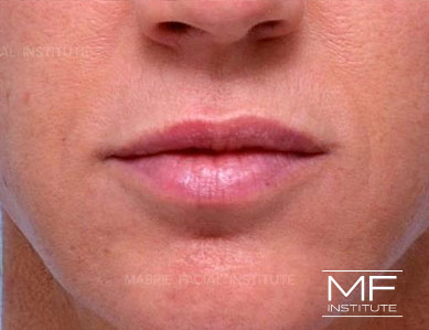 Closeup of a woman's lips after Subtle Lip Filler treatment.
